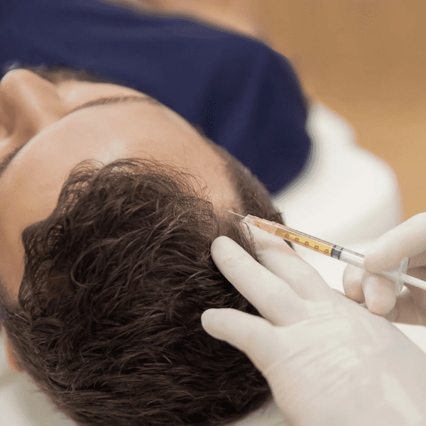 Hair restoration treatment with Platelet Rich Plasma (PRP)